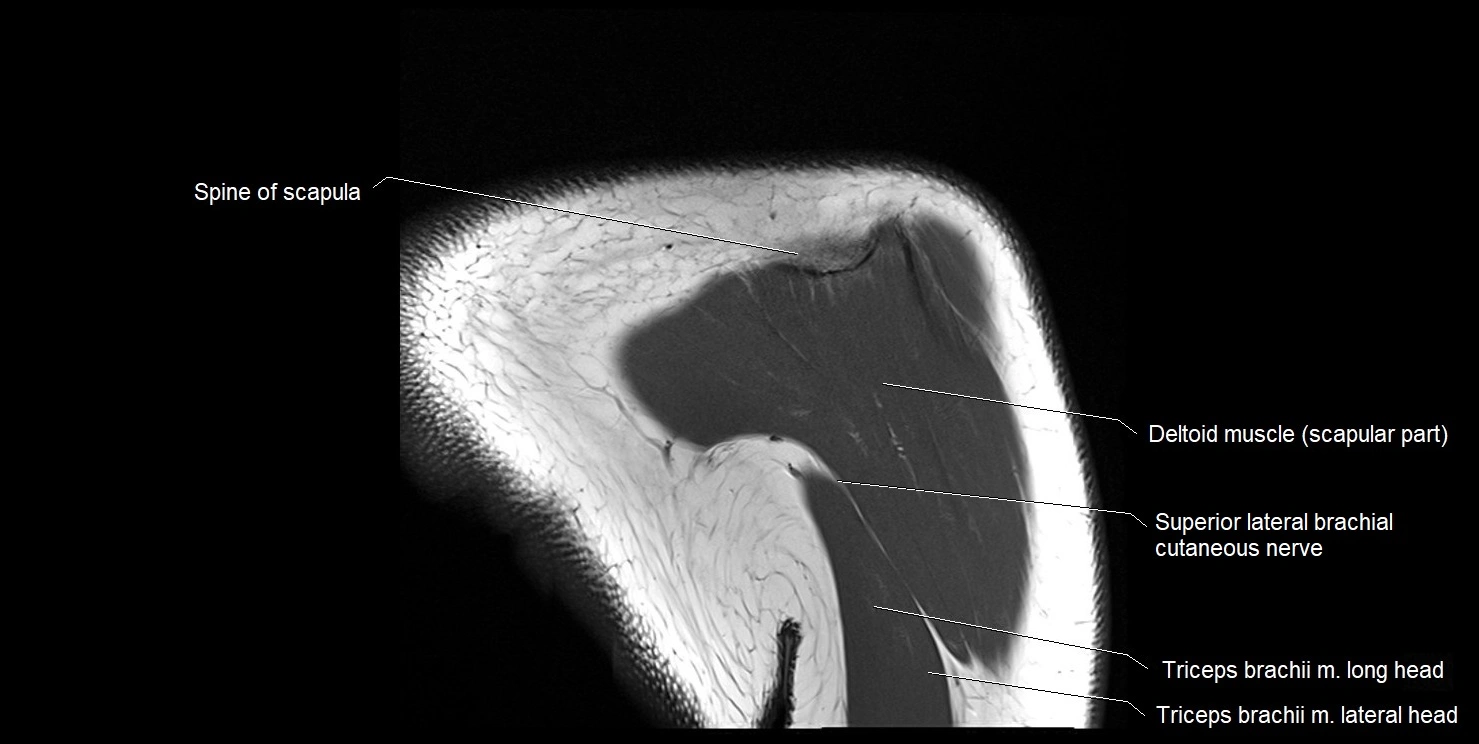 mri shoulder coronal cross sectional anatomy image 19.webp
